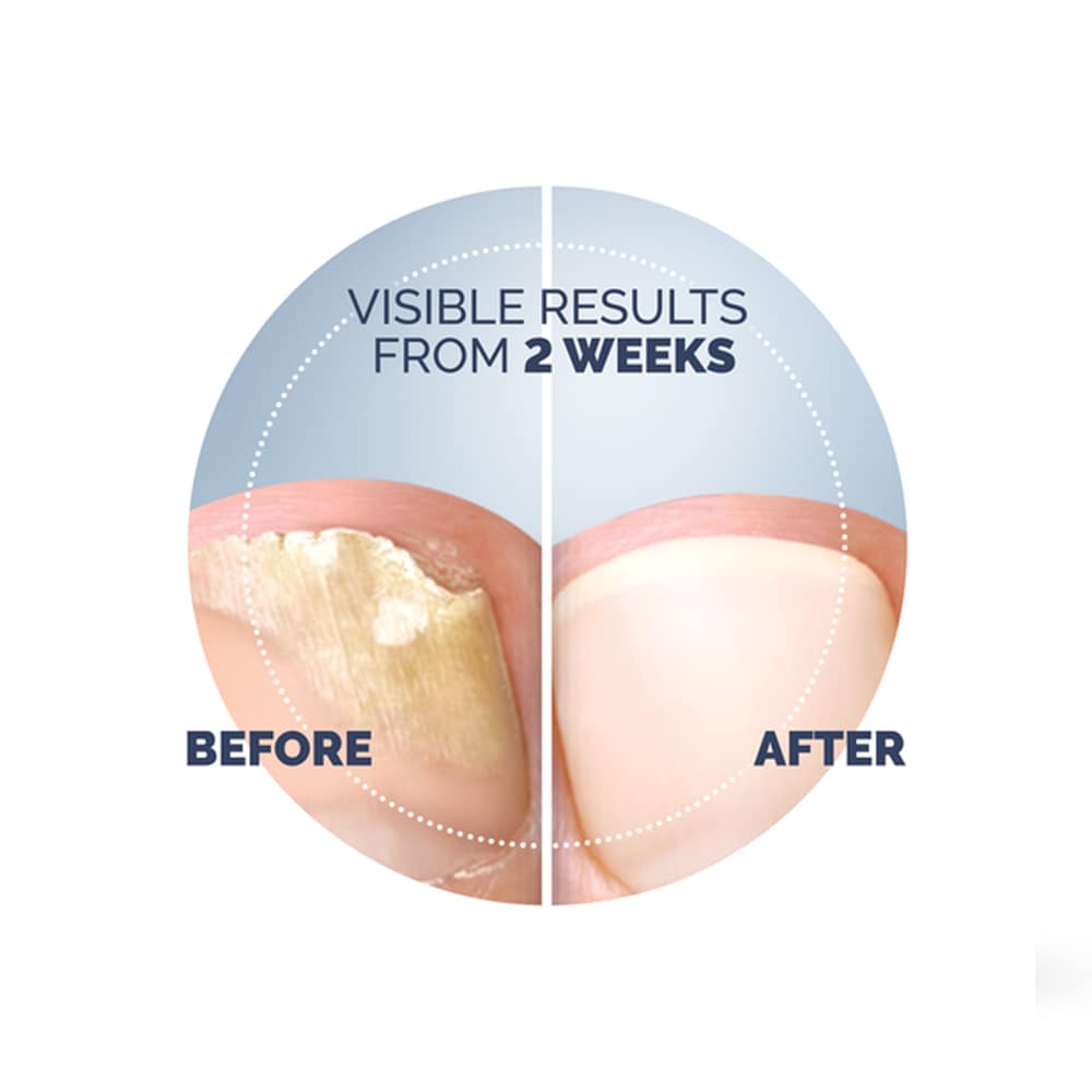 Scholl Neglesoppbehandling